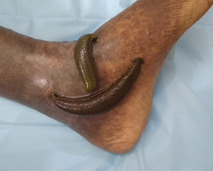 Jalookavacharanam (Leech Therapy)